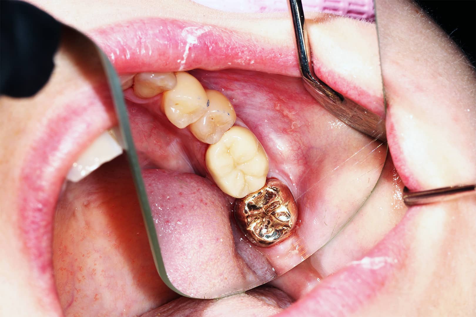 Final restorations with gold crown and composite fillings