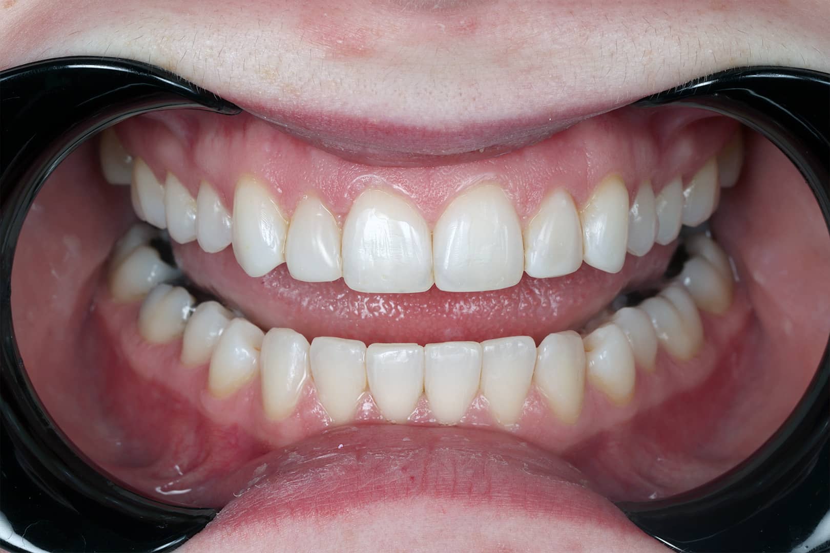 Teeth after orthodontics, refined with composite veneers for symmetry