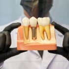 Dental implants plastic mockup