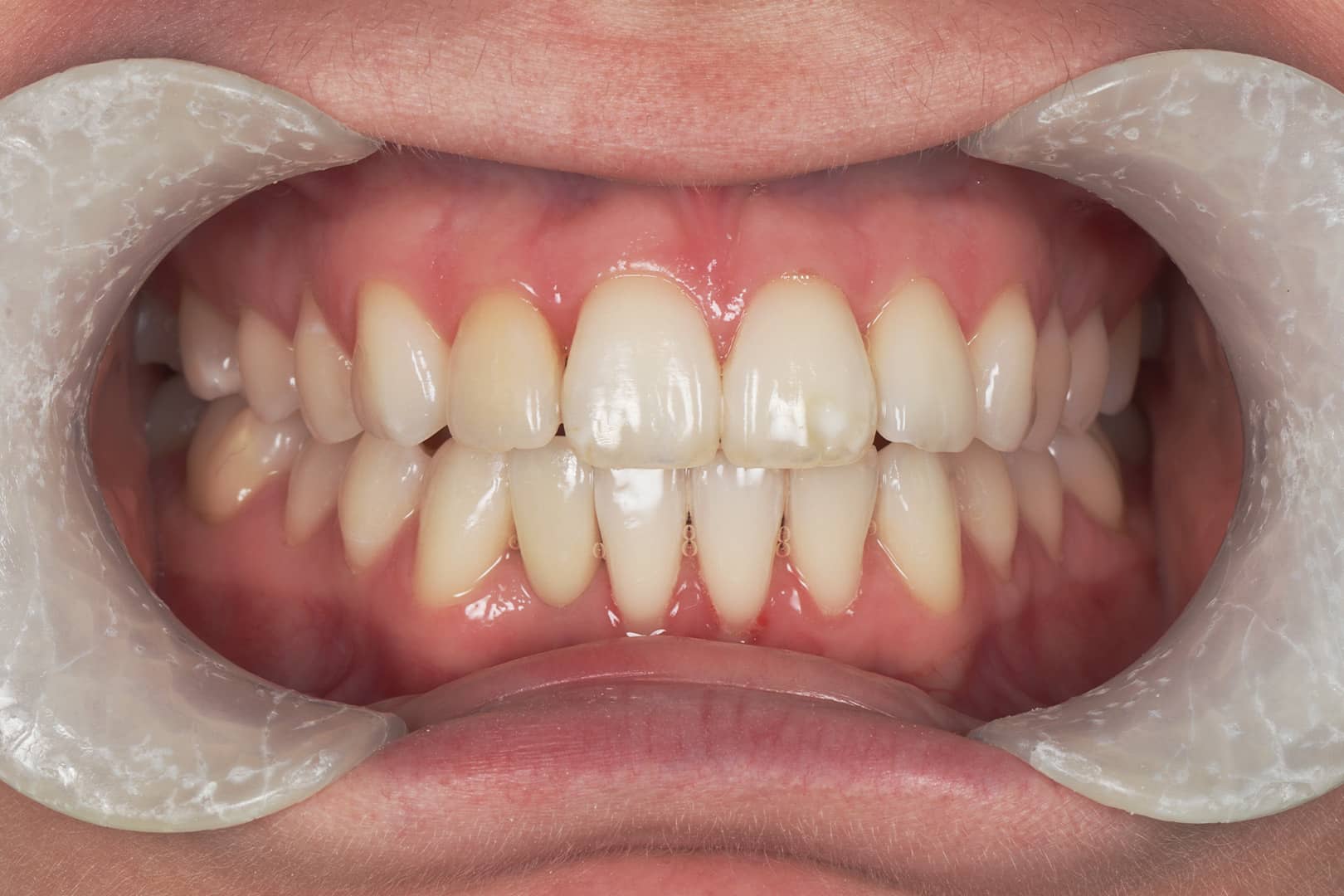 After photo of a dental bridge case by Dr Jacky at Beyond Dental Care