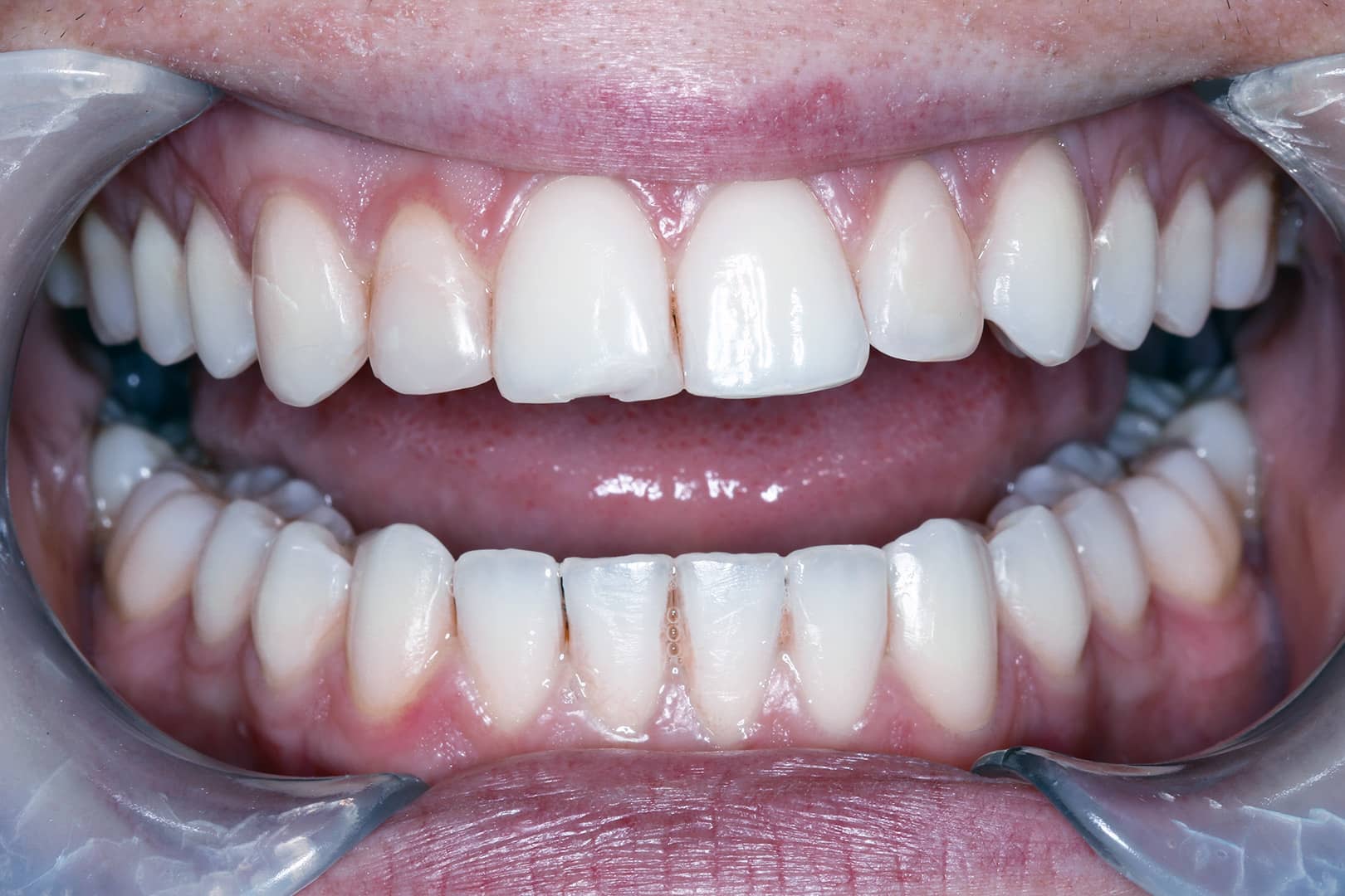 Chipped front tooth before porcelain veneer application at Burpengary dental clinic