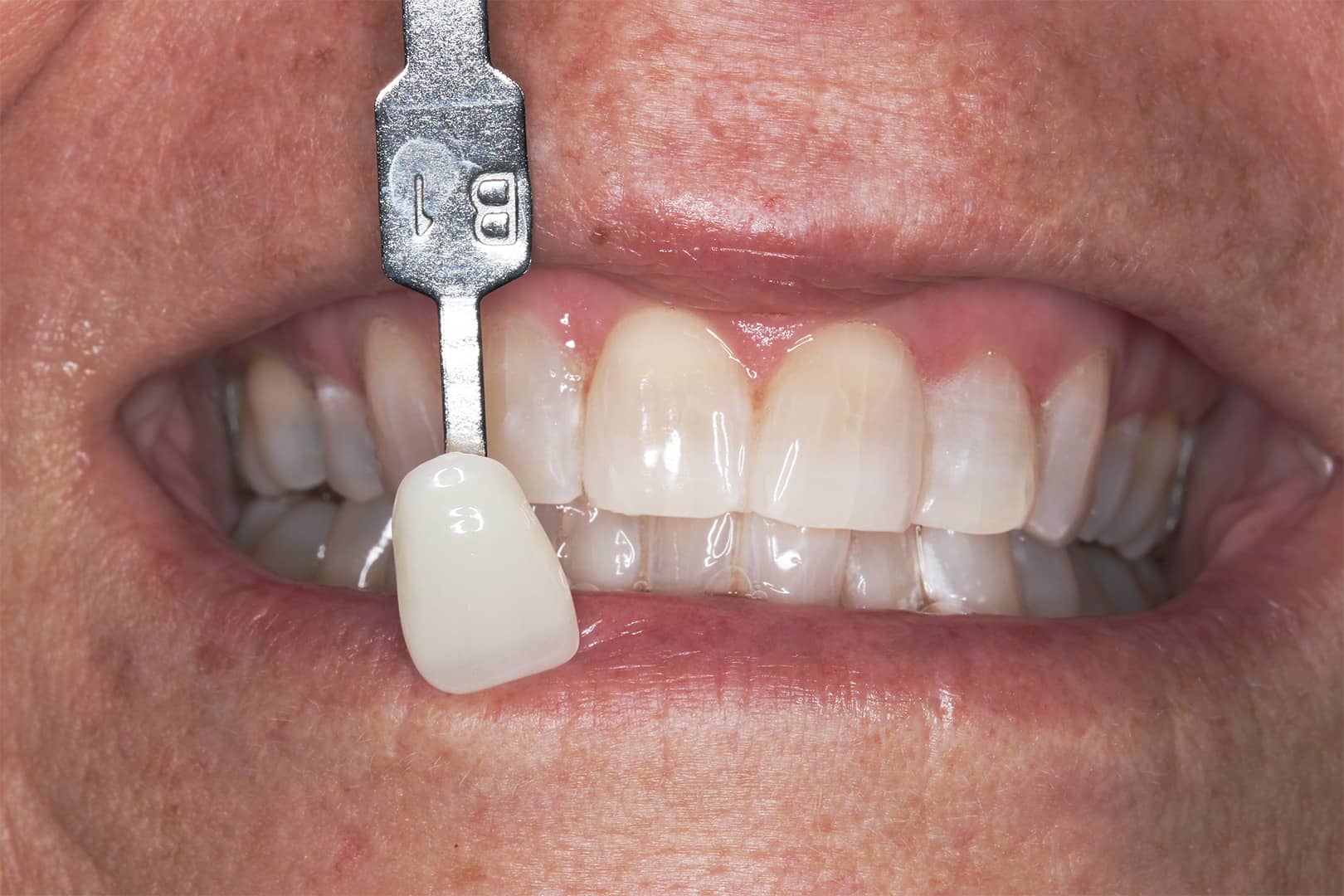 Smile after teeth whitening treatment with Dr Sein Le Way at Beyond Dental Care