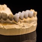 dental bridge