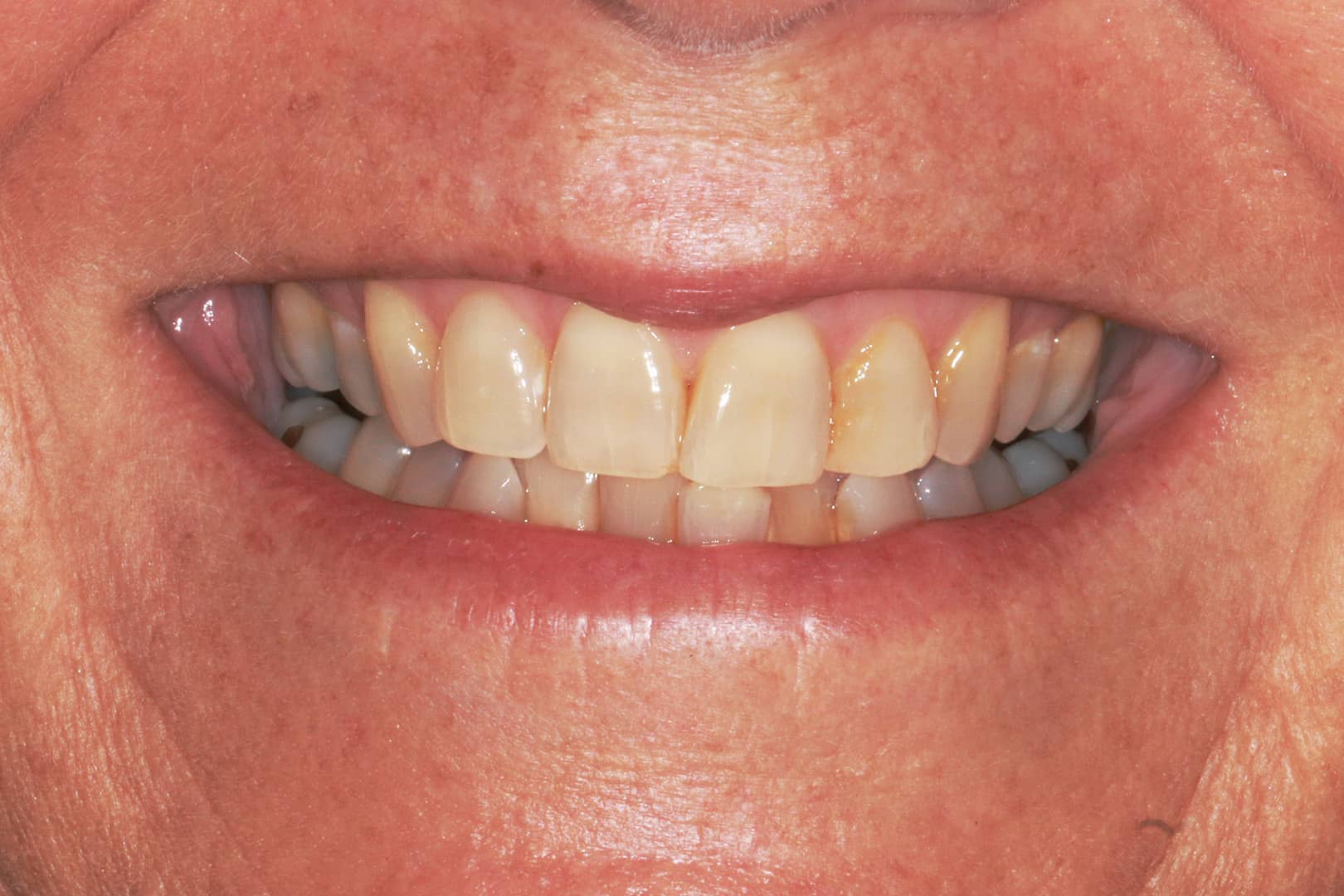 Smile before teeth whitening treatment with Dr Sein Le Way at Beyond Dental Care