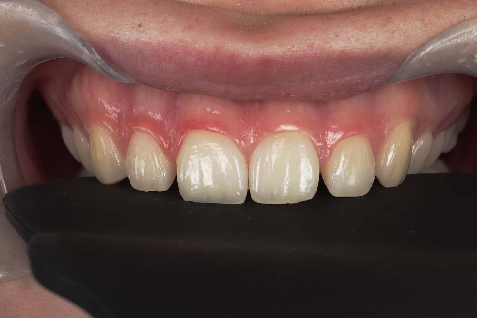 before composite veneer treatment with Dr Jacky at Beyond Dental Care.