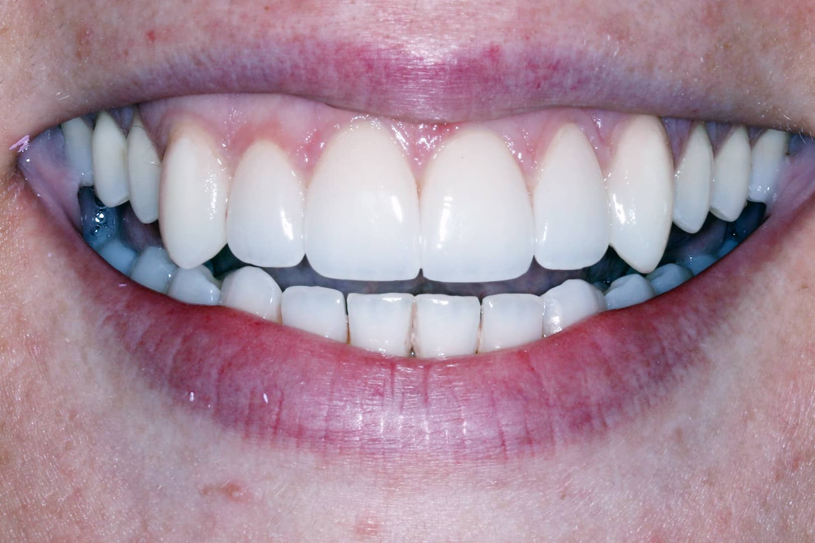 Restored smile following porcelain veneer treatment in Burpengary