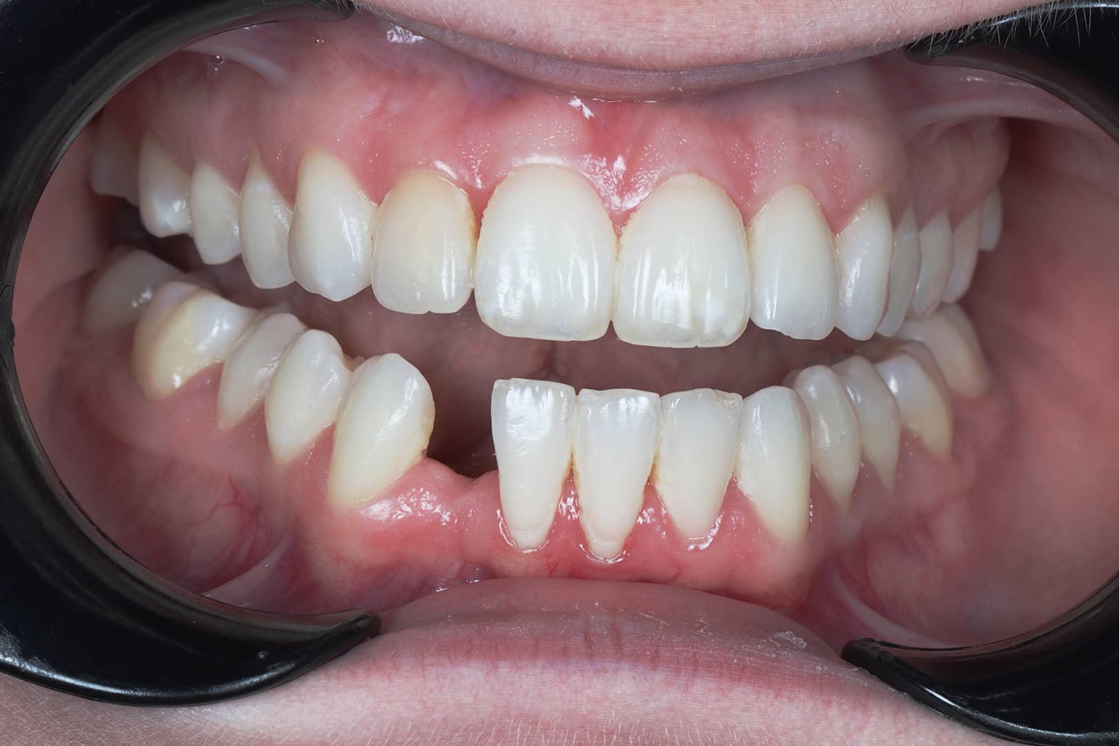 Before photo of a dental bridge case by Dr Jacky at Beyond Dental Care