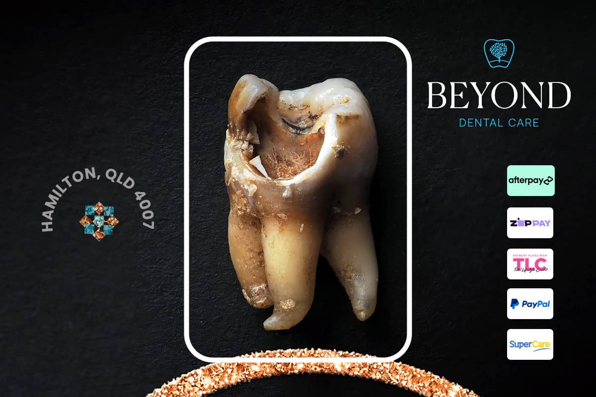 Root Canal Cost in Brisbane + What You Need to Know in 2025