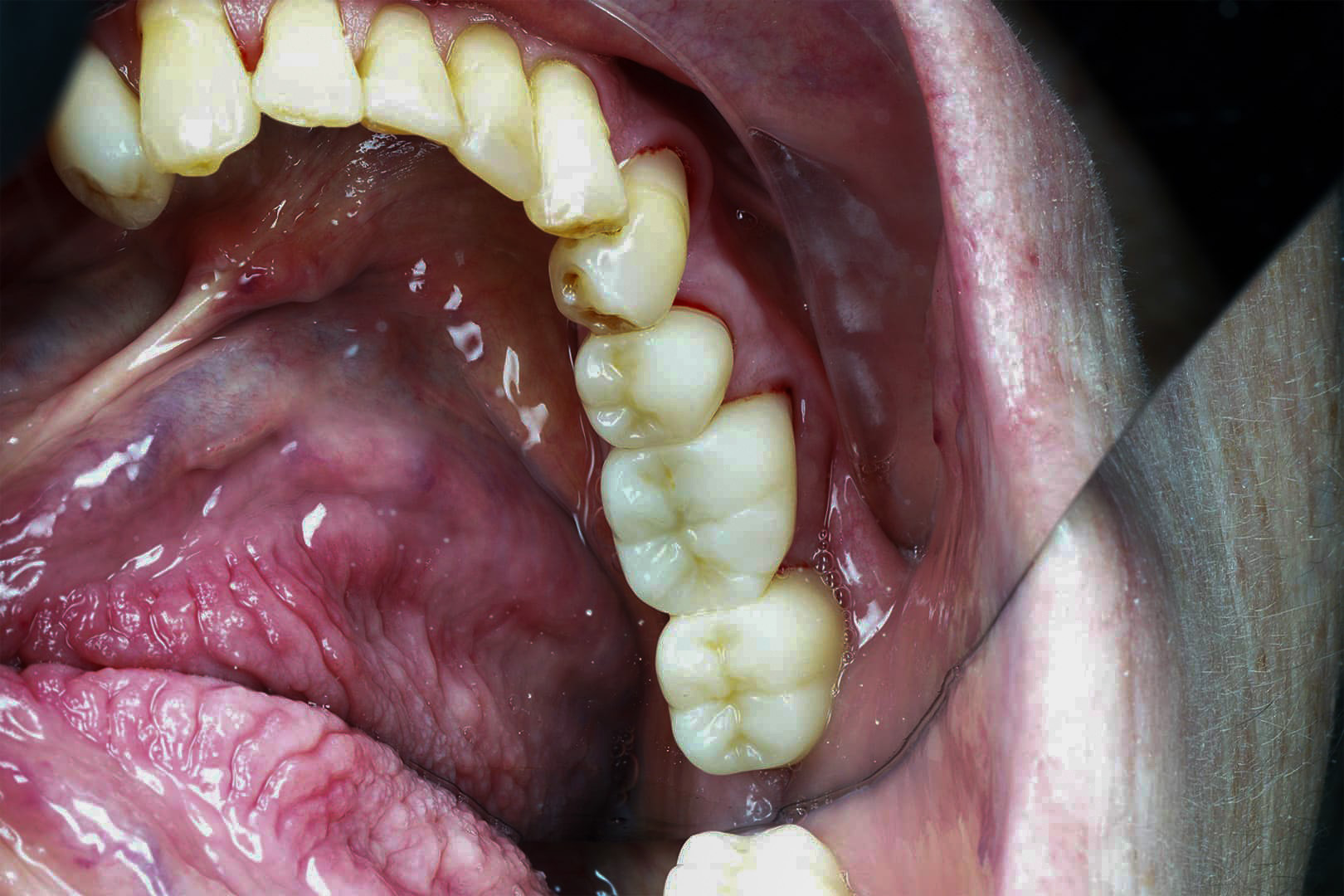 Restored lower molars with natural-coloured composite fillings placed by Dr. Jacky