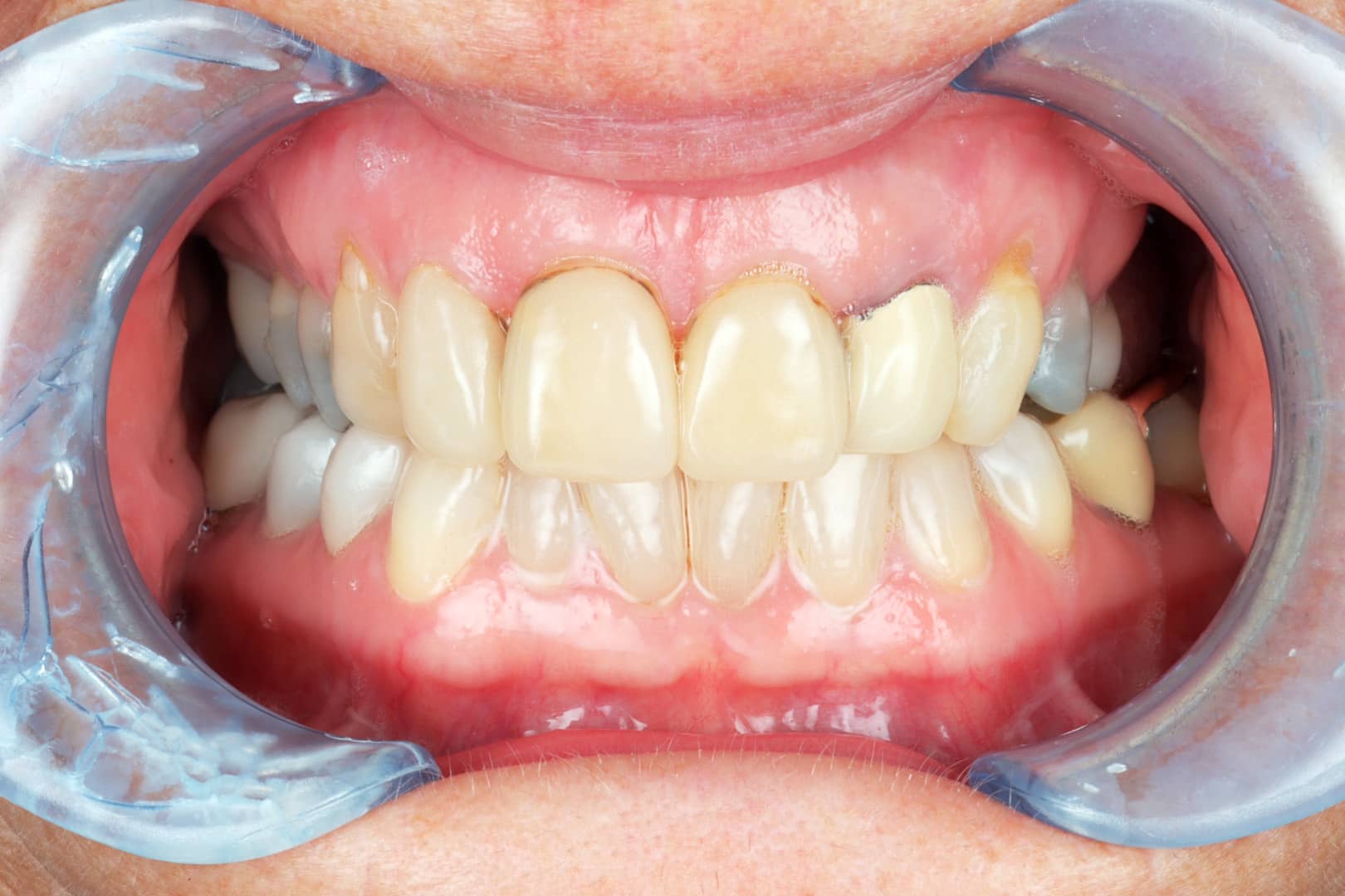 Close-up photo of a patient's smile with discoloured veneers