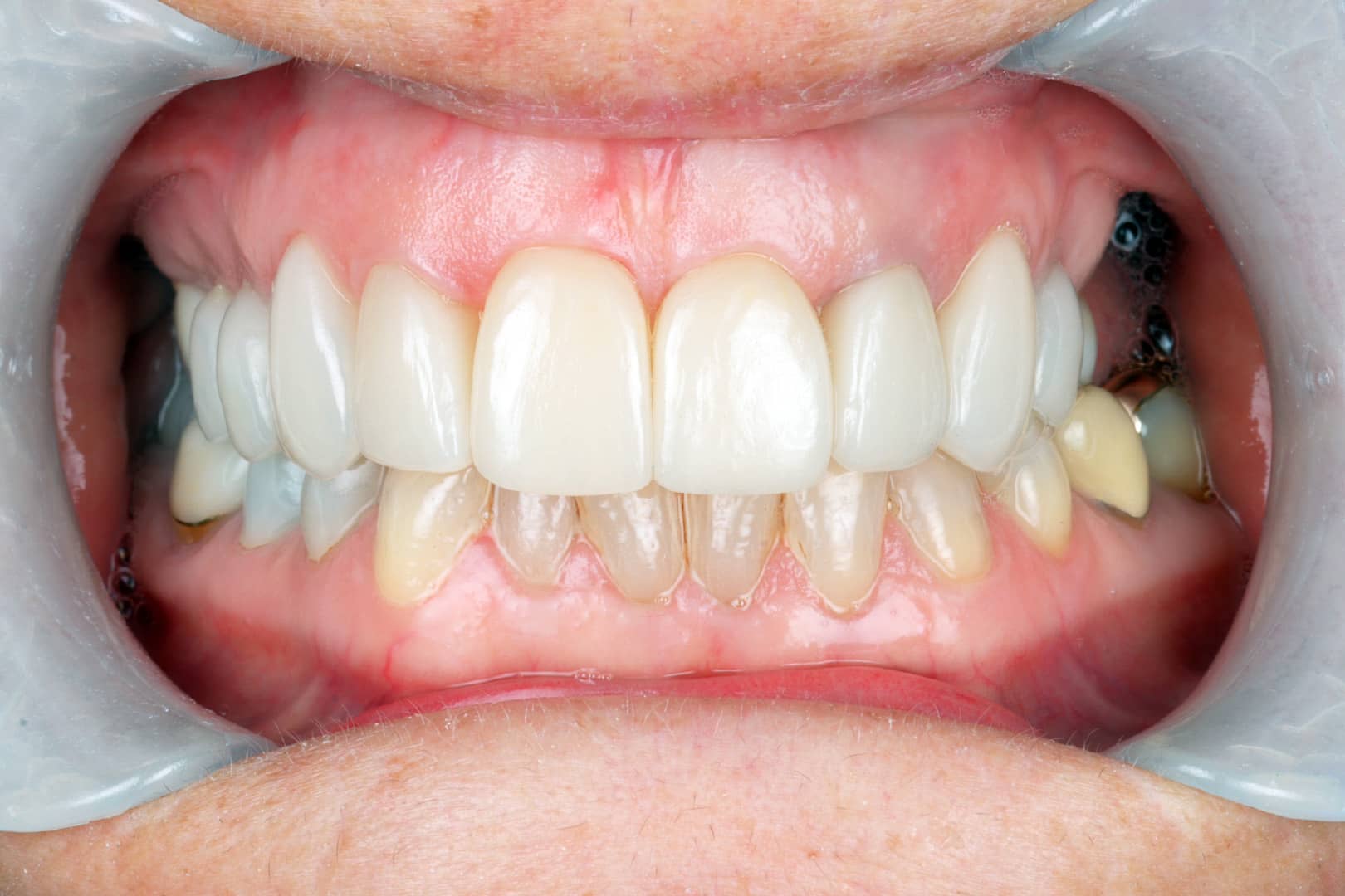 Close-up photo of a patient's smile after porcelain veneer replacement, showcasing a brighter, natural-looking smile.