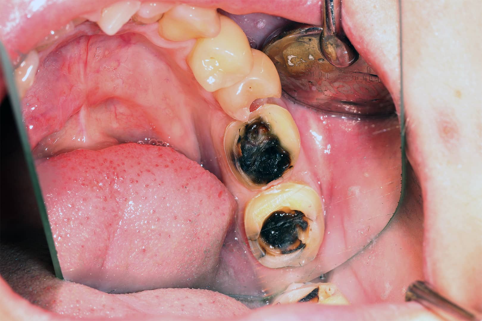 Molars with old restorations removed, showing extensive decay