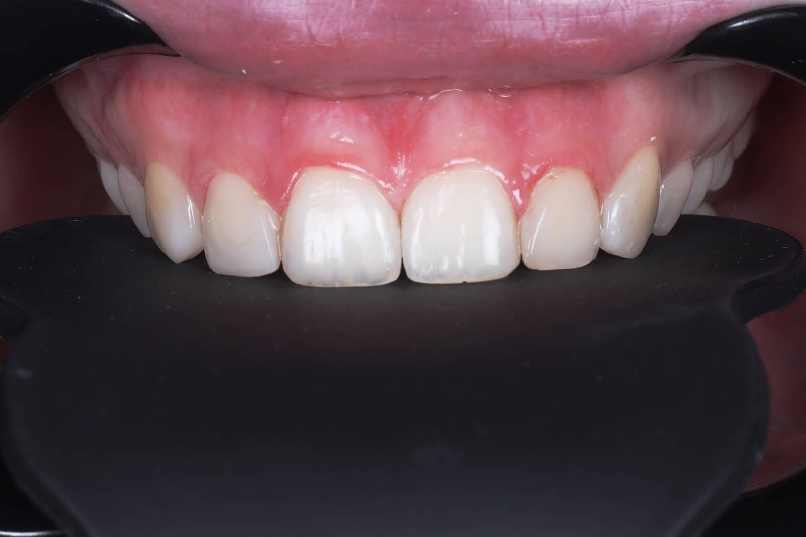 after placement of six composite veneers by Dr Jacky at Beyond Dental Care