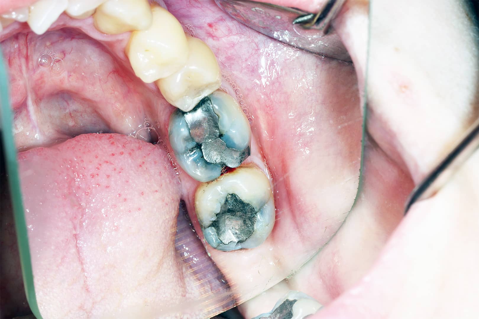 Posterior molars with cracked amalgam fillings and structural wear