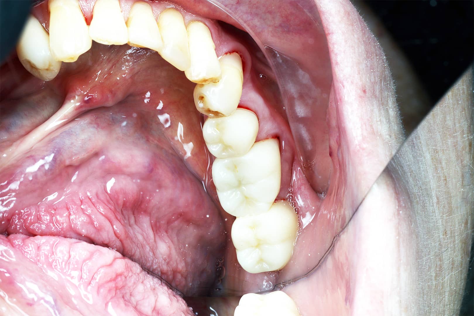 Restored lower molars with natural-coloured composite fillings placed by Dr. Jacky