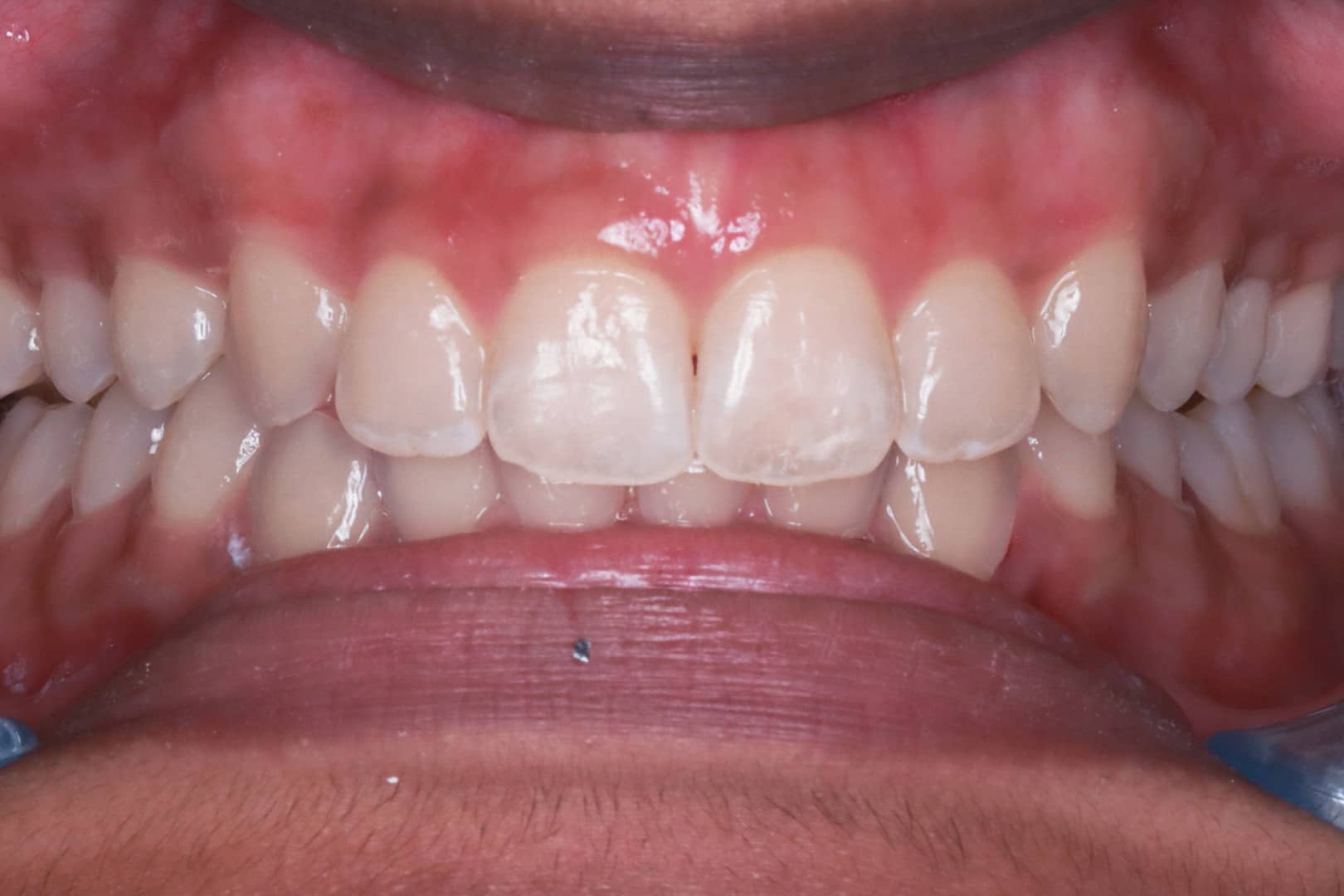 Close-up of straight, aligned teeth after clear aligner treatment performed by Dr Mitesh Vasant at Beyond Dental Care