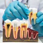 teeth mockup root canal dental implant