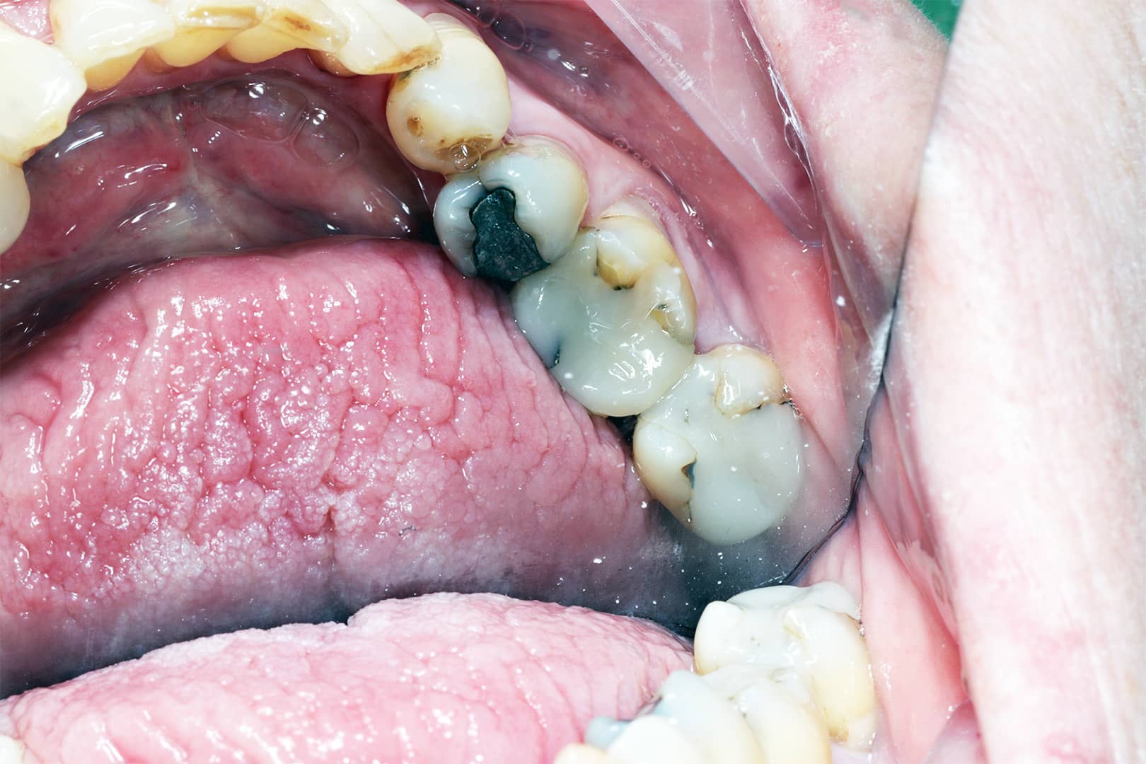 Lower molars with old amalgam fillings and visible decay prior to dental restoration.