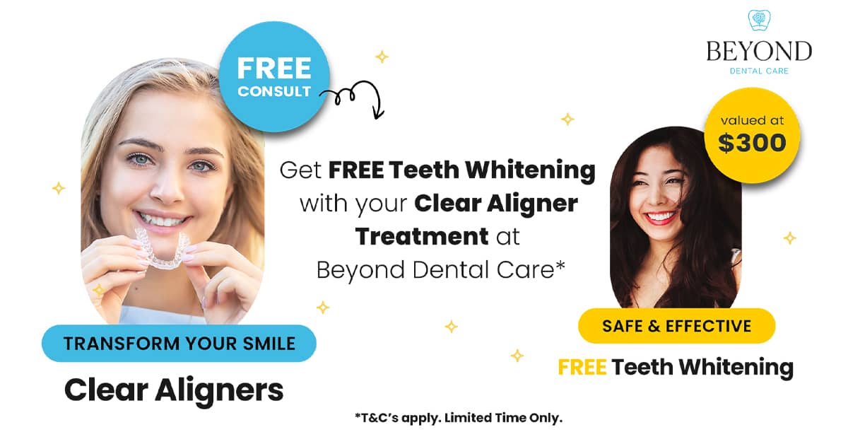 Free Teeth Whitening with Clear Aligners AprilMay 2024