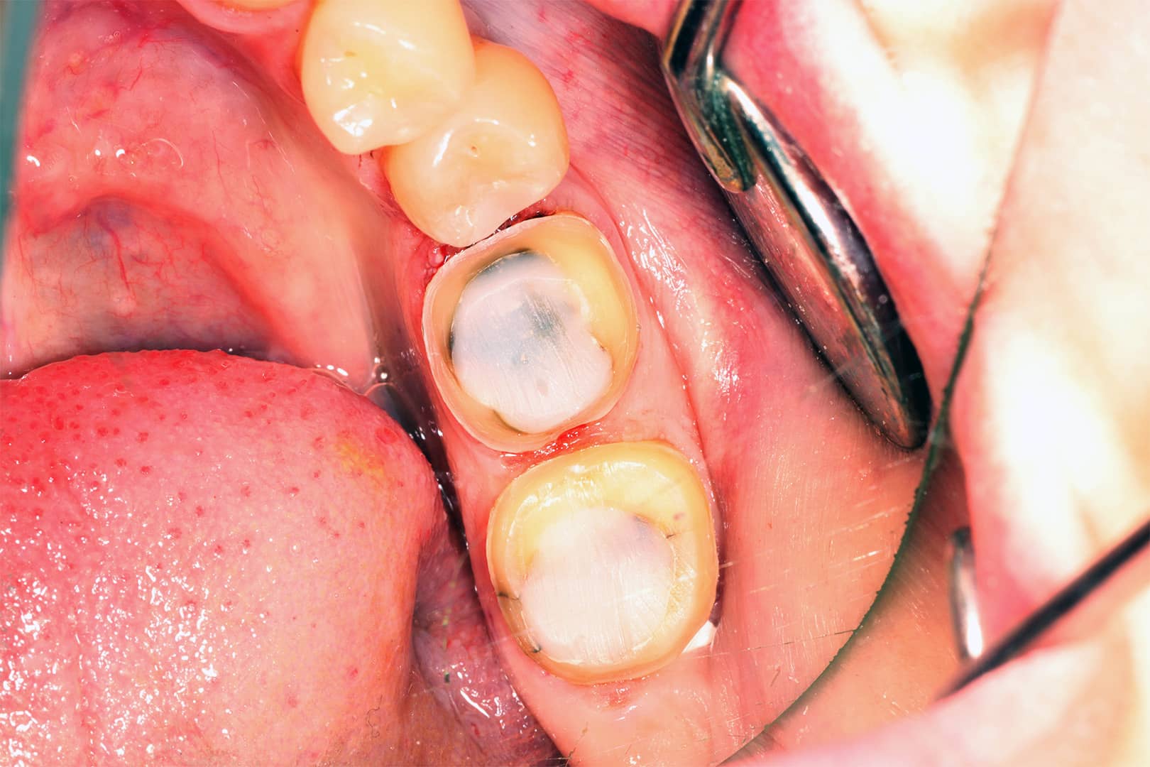 Composite build-ups on posterior teeth after caries removal