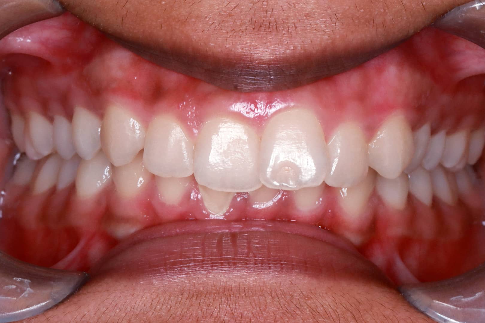 Close-up of misaligned teeth before clear aligner treatment performed by Dr Mitesh Vasant at Beyond Dental Care