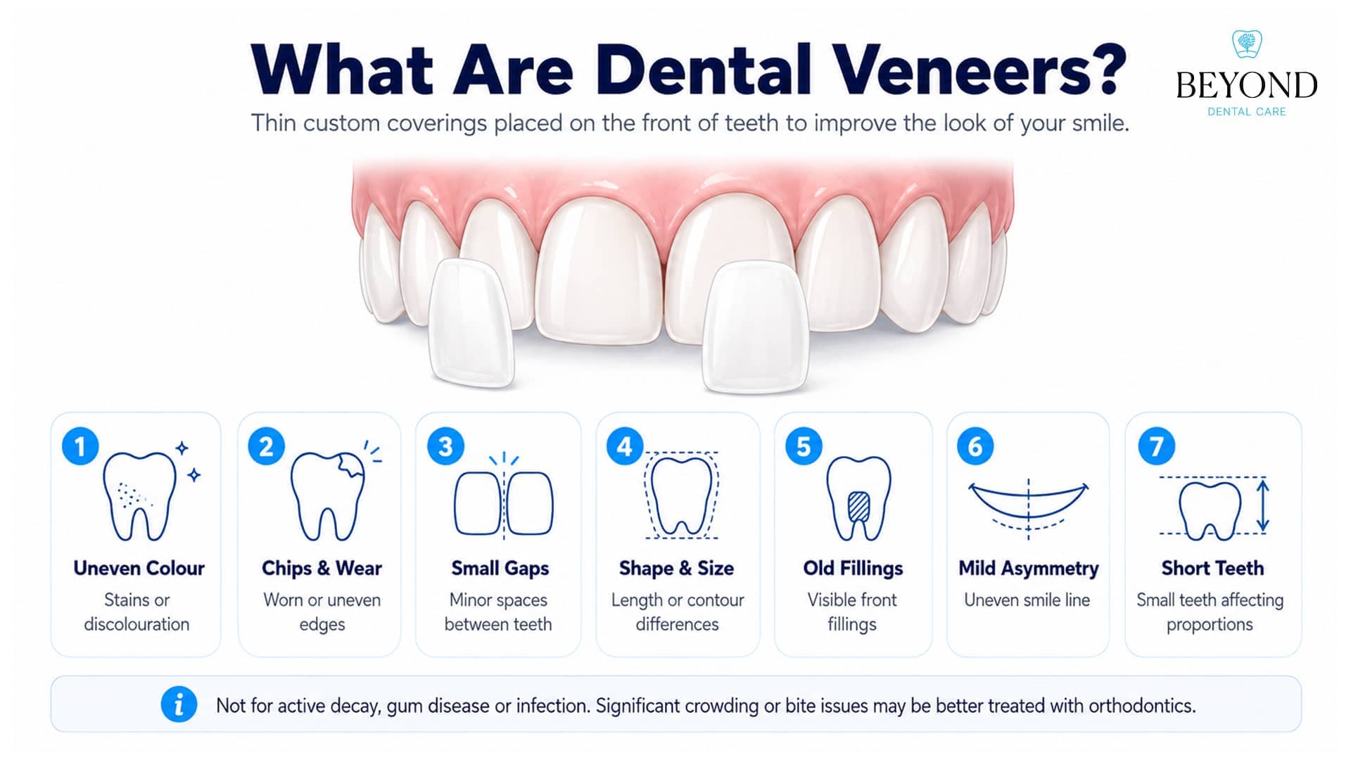 Infographic explaining what dental veneers are and the concerns they may improve