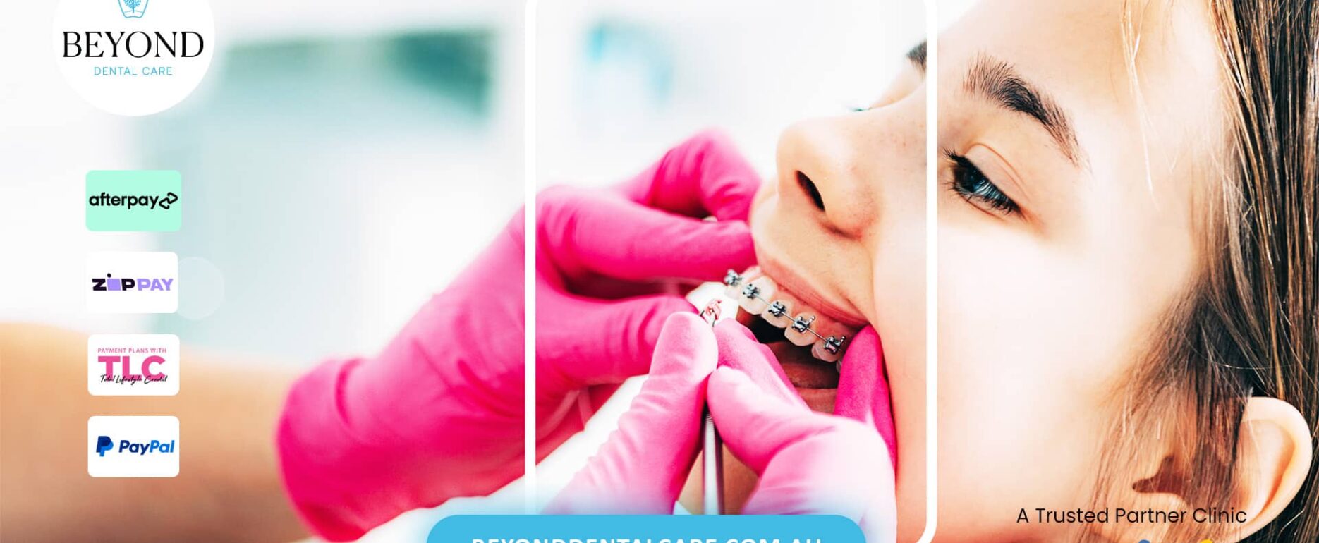 Metal Braces in Brisbane Orthodontics for Complex Dental Corrections