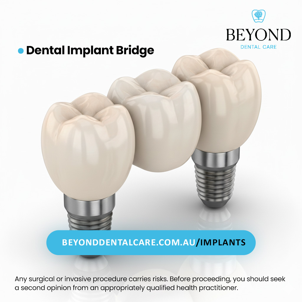 photograph of a three-unit dental implant bridge replacing three missing posterior teeth on the lower right side of the jaw.