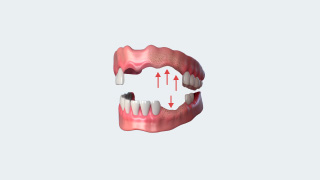 Experiencing jawbone shrinkage problem dental implants Brisbane