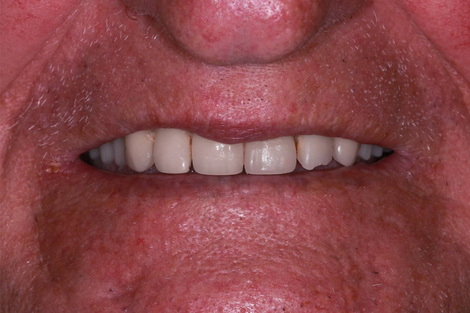 Henderik with 40-year-old dentures that lost all retention before photo Results - See the Gallery of Before and After