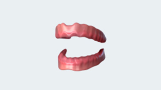 Missing most or all of your teeth problem dental implants Brisbane