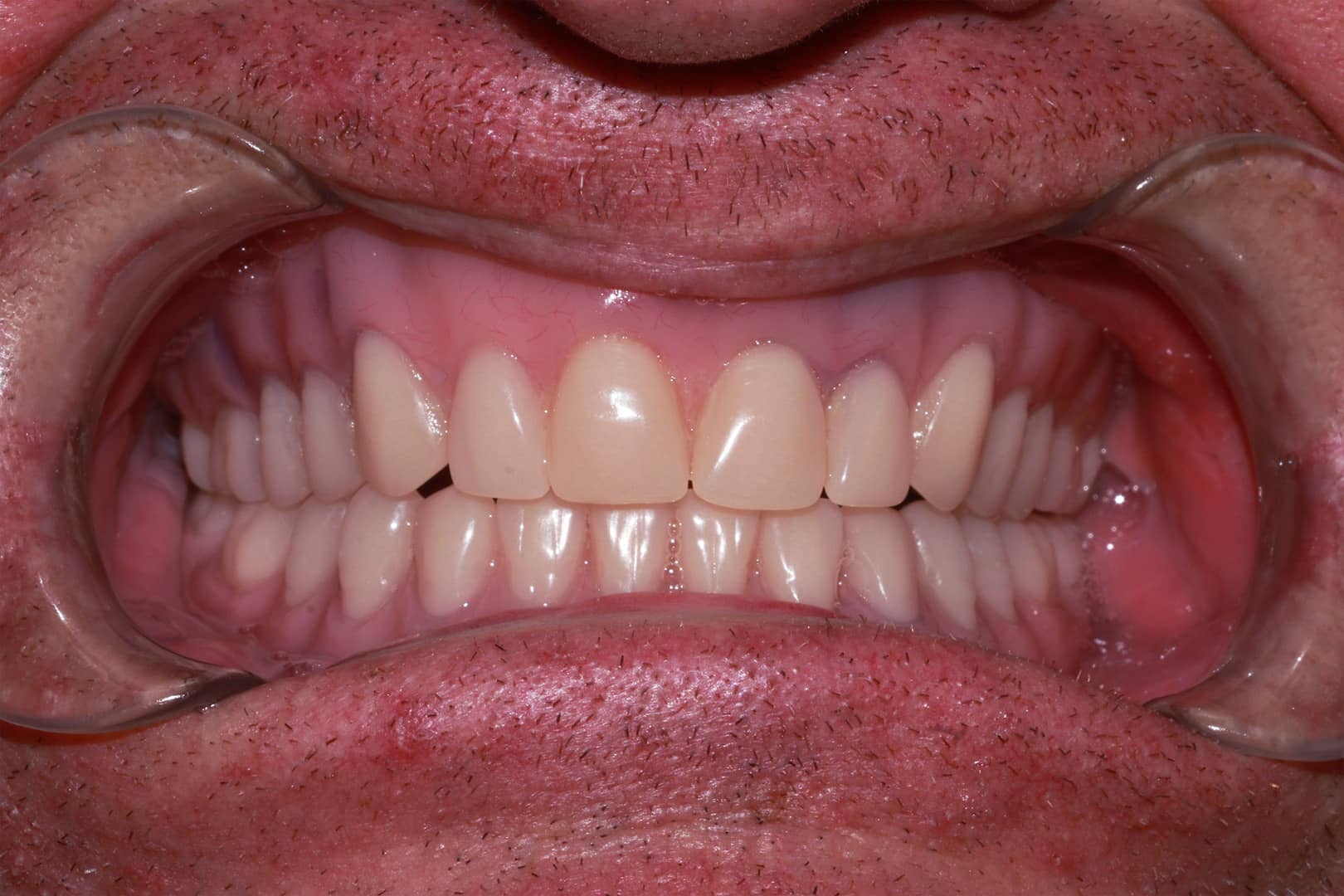 Remy Full Dentures great transformation after See the Gallery of Before and After