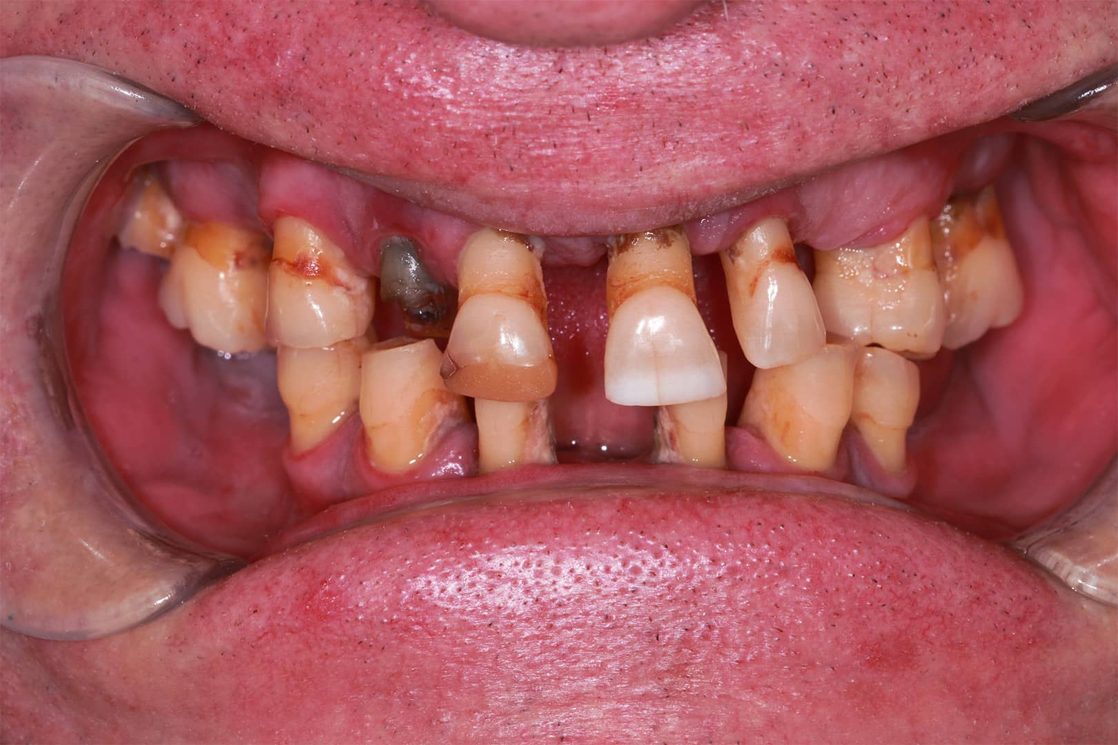 Remy Full Dentures great transformation before Results - See the Gallery of Before and After