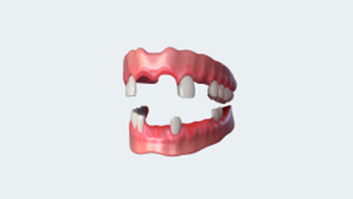 Struggling with advanced gum disease problem dental implants Brisbane