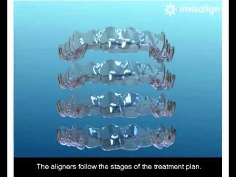 Invisalign vs Braces- Which Is Right For Your Smile?