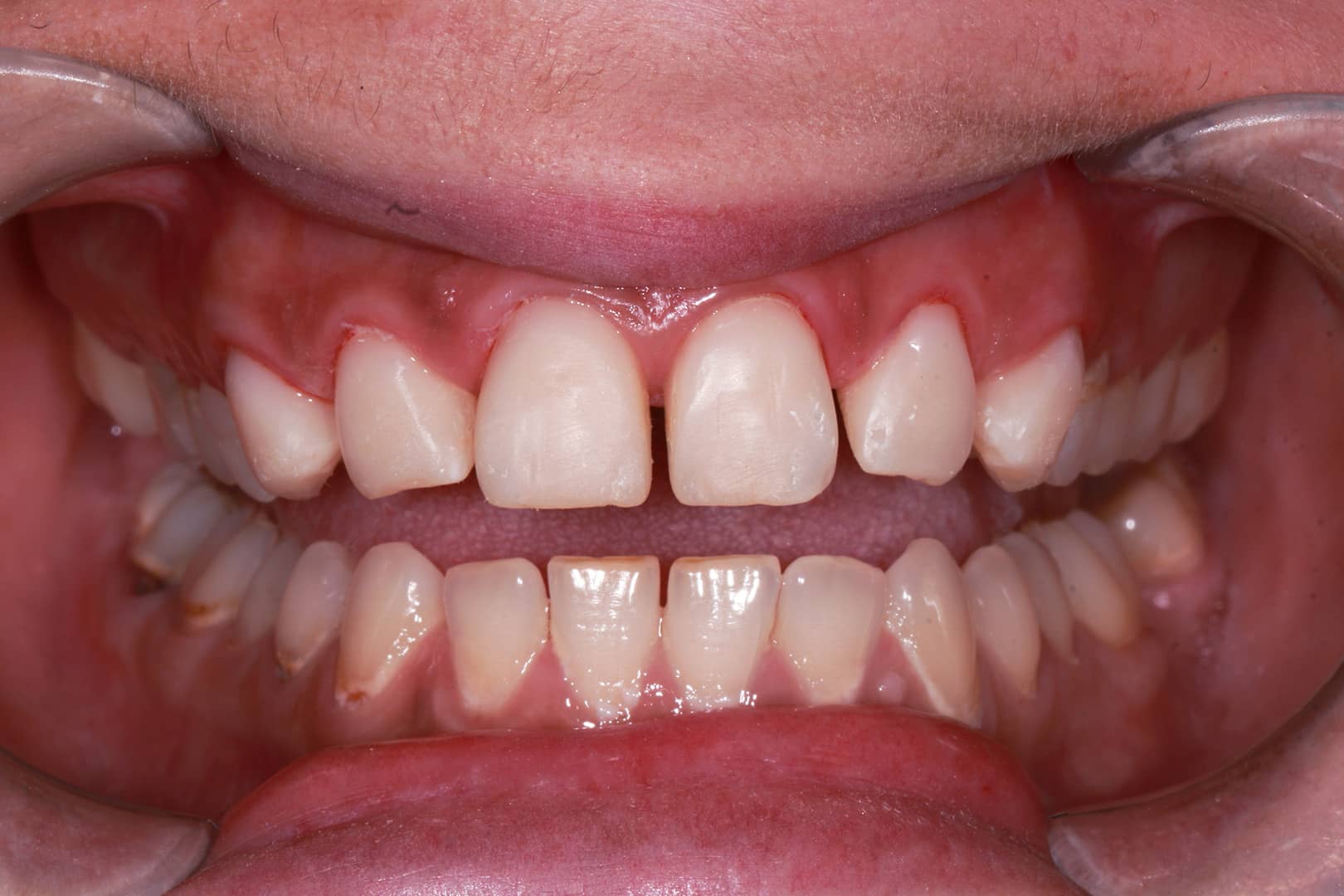 Gallery of Patient Dental Bonding Treatment Humm Payment Results See the Gallery of After Photos
