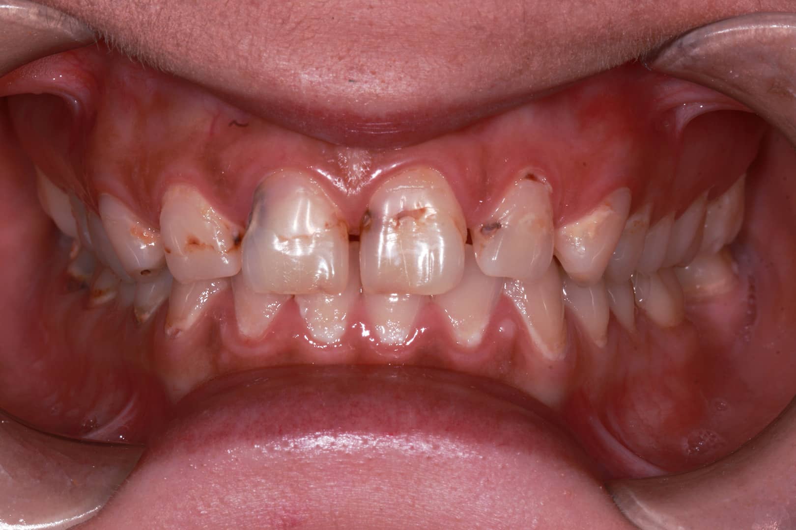 Gallery of Patient Dental Bonding Treatment Humm Payment Results See the Gallery of Before Photo