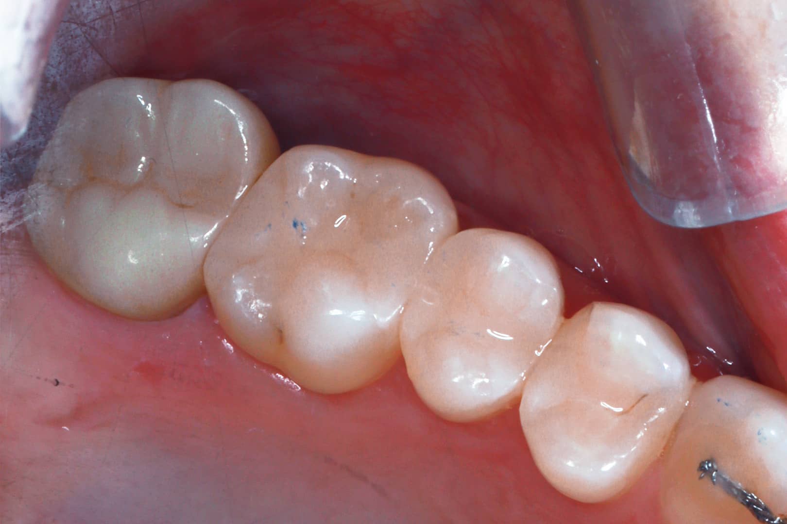 Before Photo - A Patient Journey to Pain-Free Living with Root Canal Therapy and Ceramic Crowns by Dr Mitesh Vasant