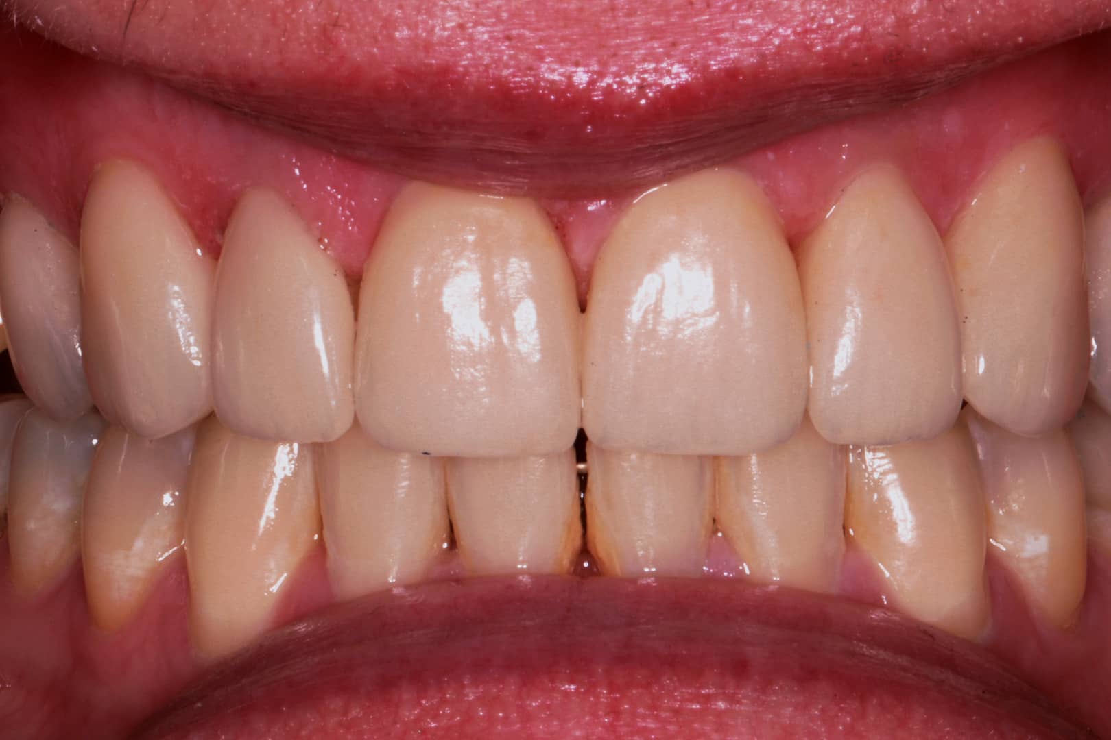 After Photo - Sarah's Dream Smile for Her Big Day Ceramic Crowns by Dr Mitesh Vasant