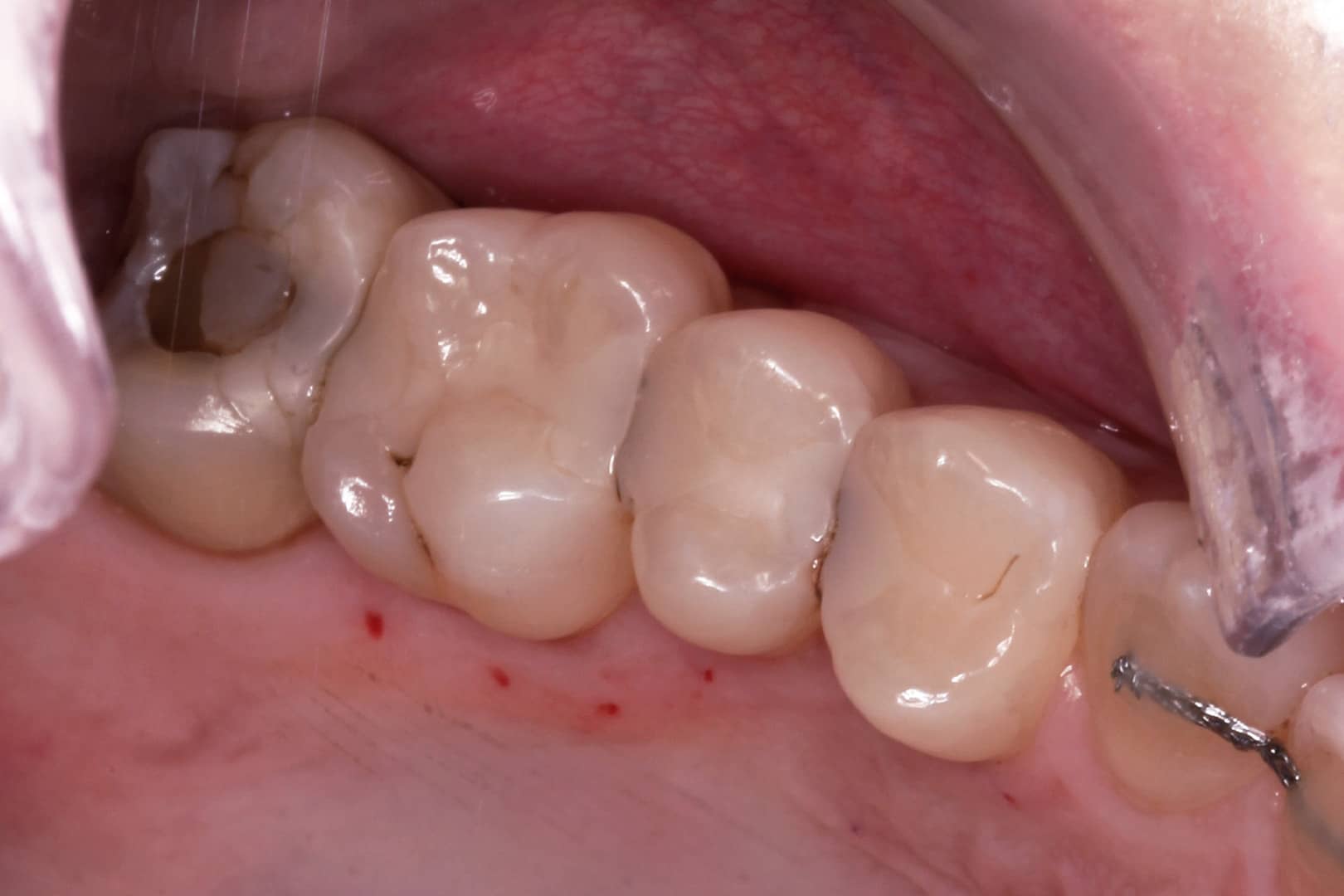 Before Photo - A Patient Journey to Pain-Free Living with Root Canal Therapy and Ceramic Crowns by Dr Mitesh Vasant