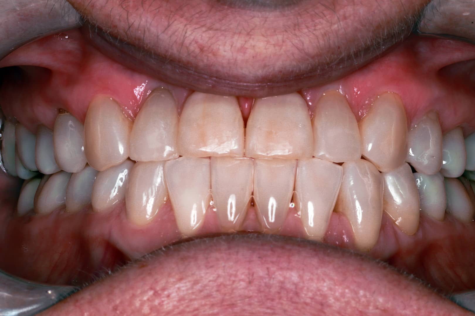 After Photo Showing Sharons Transformational Journey with Clear Aligners