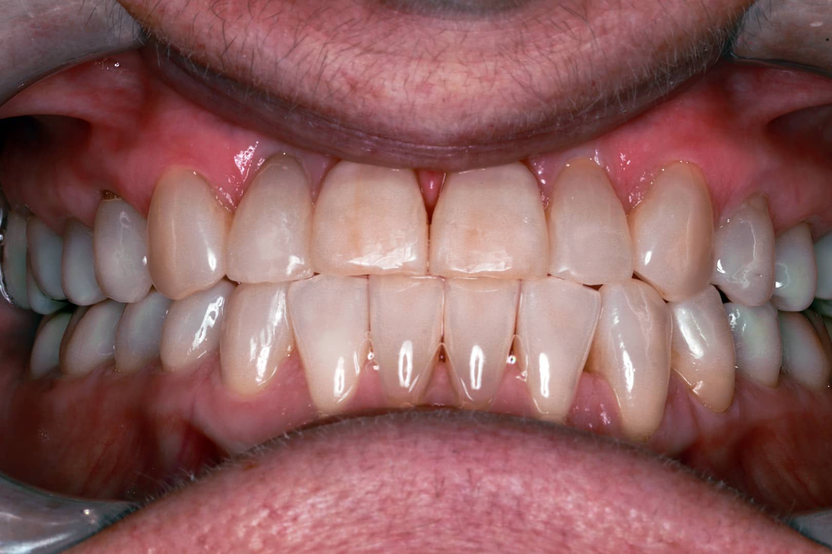 After Photo Showing Sharons Transformational Journey with Clear Aligners In our gallery, you'll find frequently updated and diverse collection of before and after photos, so you can see the incredible results for yourself. From teeth whitening and cosmetic bonding to dental implants and full mouth reconstructions, we leverage the power of cutting-edge tools and approaches, to help you achieve the stunning, confident smile that lasts.