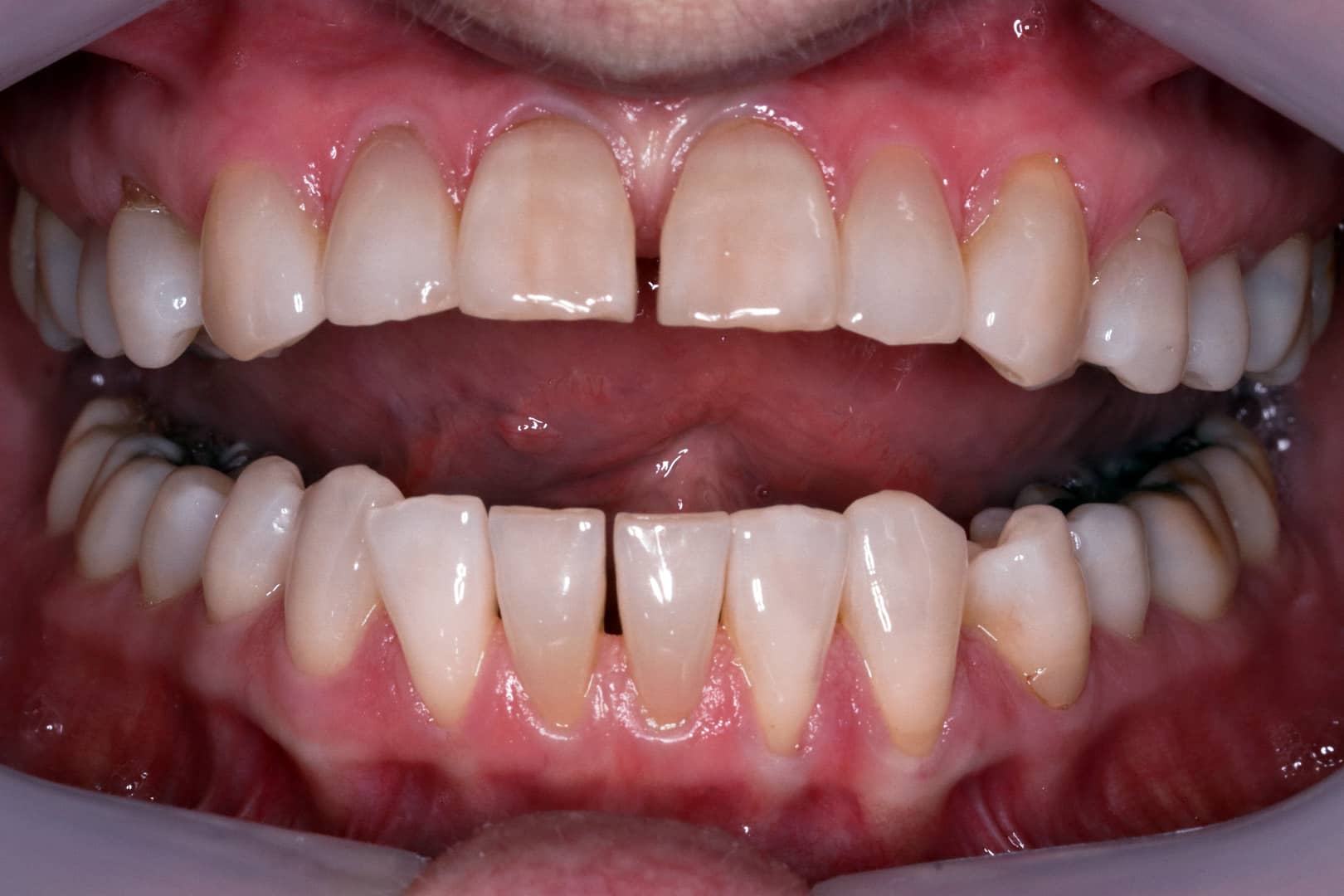 Before Photo Illustrating Sharons Transformational Journey with Clear Aligners