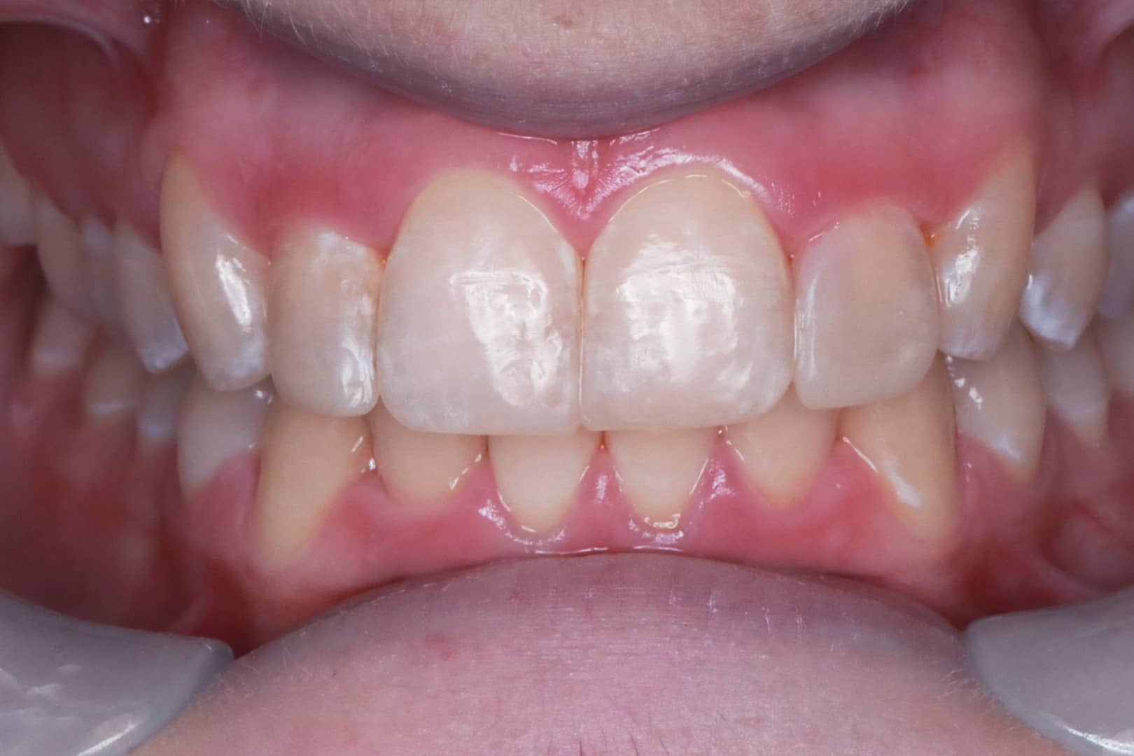 After Photo February 2024 Clear Aligners and Dental Bonding Treatment Continues