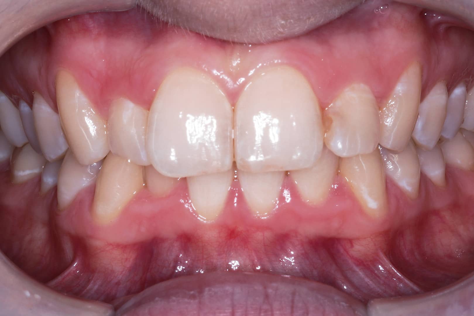 Before Photo March 2023 Clear Aligners Treatment Start