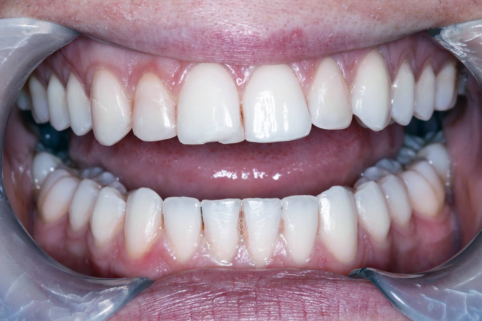 Chipped front tooth before porcelain veneer application at Burpengary dental clinic