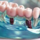 Dental implant, artificial tooth model