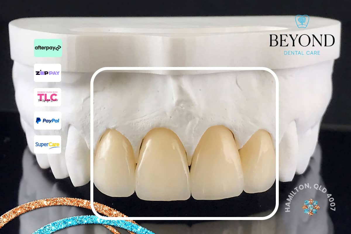 Urgent dental care for crowns that fall out during meals or daily activity