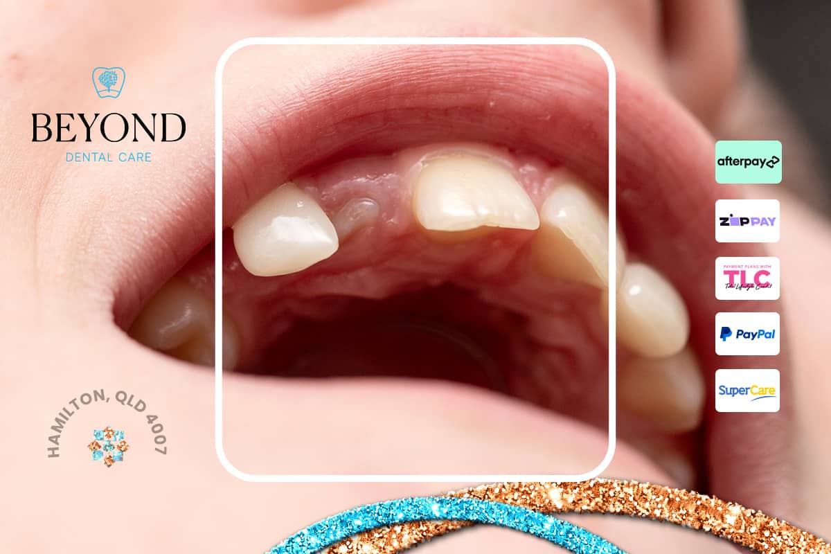 Emergency dental treatment for dry socket after tooth extraction