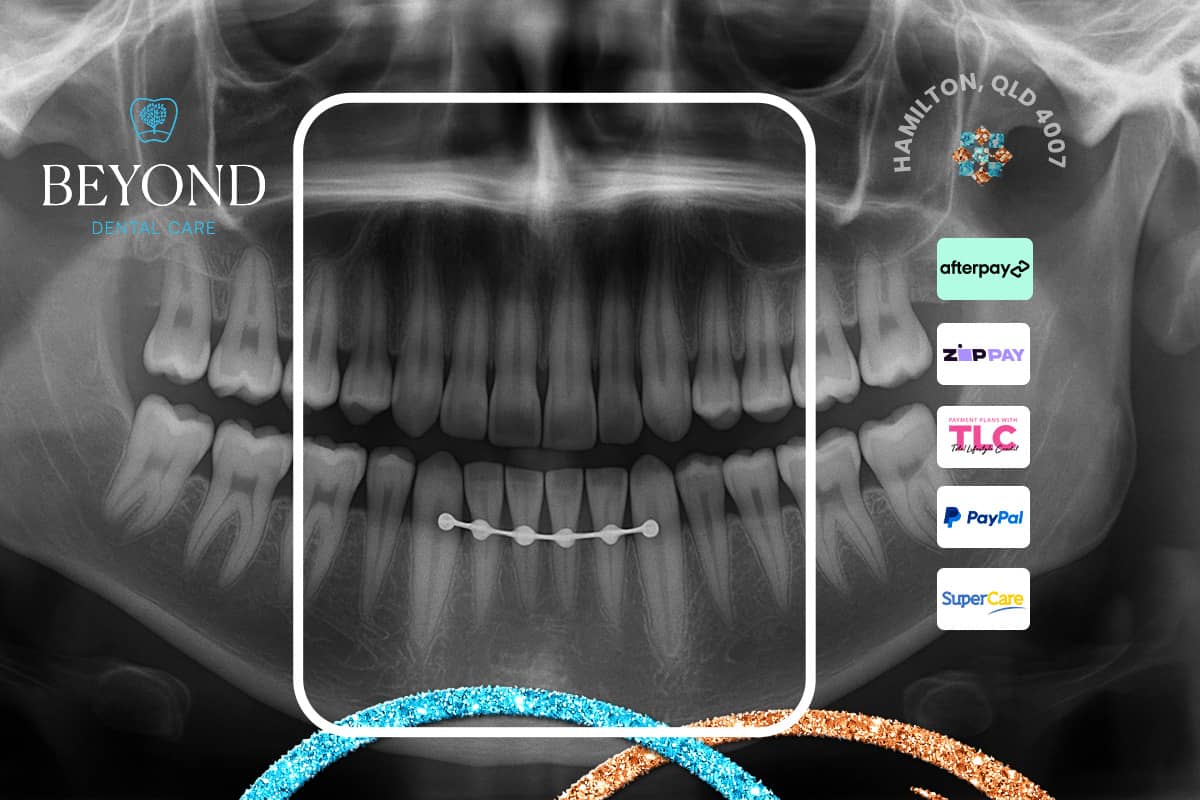 Emergency splinting protocol to stabilise displaced or mobile teeth after dental trauma